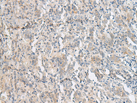 Immunohistochemistry of paraffin-embedded Human cervical cancer tissue using PCSK5 Polyclonal Antibody at dilution of 1:50 (×200)
