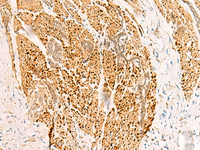 Immunohistochemistry of paraffin-embedded Human esophagus cancer tissue using RFX6 Polyclonal Antibody at dilution of 1:50 (×200)