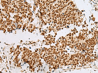 Immunohistochemistry of paraffin-embedded Human lung cancer tissue using RBM12 Polyclonal Antibody at dilution of 1:50 (×200)