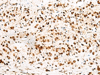 Immunohistochemistry of paraffin-embedded Human prost ate cancer tissue using RBM12 Polyclonal Antibody at dilution of 1:50 (×200)