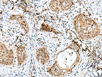 Immunohistochemistry of paraffin-embedded Human esophagus cancer tissue using RBM15 Polyclonal Antibody at dilution of 1:50 (×200)