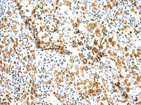 Immunohistochemistry of paraffin-embedded Human cervical cancer tissue using TCOF1 Polyclonal Antibody at dilution of 1:50 (×200)