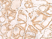 Immunohistochemistry of paraffin-embedded Human thyroid cancer tissue using RBM19 Polyclonal Antibody at dilution of 1:30 (×200)