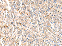 Immunohistochemistry of paraffin-embedded Human cervical cancer tissue using RBM19 Polyclonal Antibody at dilution of 1:30 (×200)
