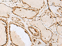 Immunohistochemistry of paraffin-embedded Human thyroid cancer tissue using IPO11 Polyclonal Antibody at dilution of 1:65 (×200)