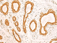 Immunohistochemistry of paraffin-embedded Human breast cancer tissue using ZNF471 Polyclonal Antibody at dilution of 1:50 (×200)