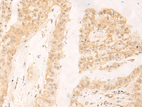 Immunohistochemistry of paraffin-embedded Human liver cancer tissue using RBX1 Polyclonal Antibody at dilution of 1:30 (×200)