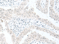 Immunohistochemistry of paraffin-embedded Human liver cancer tissue using ENSA Polyclonal Antibody at dilution of 1:70 (×200)