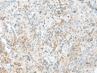 Immunohistochemistry of paraffin-embedded Human cervical cancer tissue using ENSA Polyclonal Antibody at dilution of 1:70 (×200)