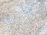 Immunohistochemistry of paraffin-embedded Human cervical cancer tissue using RPP14 Polyclonal Antibody at dilution of 1:60 (×200)