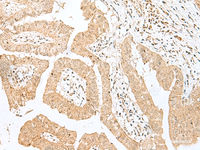 Immunohistochemistry of paraffin-embedded Human liver cancer tissue using BEX2 Polyclonal Antibody at dilution of 1:50 (×200)