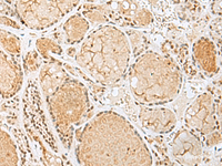 Immunohistochemistry of paraffin-embedded Human thyroid cancer tissue using HIST1H2BK Polyclonal Antibody at dilution of 1:60 (×200)