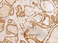 Immunohistochemistry of paraffin-embedded Human thyroid cancer tissue using H3F3B Polyclonal Antibody at dilution of 1:40 (×200)