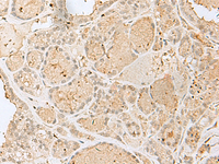 Immunohistochemistry of paraffin-embedded Human thyroid cancer tissue using GOLGA7 Polyclonal Antibody at dilution of 1:40 (×200)