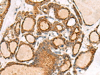 Immunohistochemistry of paraffin-embedded Human thyroid cancer tissue using NPC2 Polyclonal Antibody at dilution of 1:50 (×200)