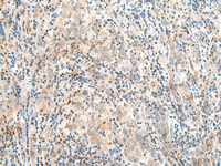 Immunohistochemistry of paraffin-embedded Human cervical cancer tissue using JPT1 Polyclonal Antibody at dilution of 1:35 (×200)