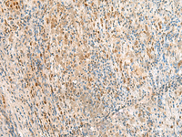 Immunohistochemistry of paraffin-embedded Human cervical cancer tissue using RPS27A Polyclonal Antibody at dilution of 1:35 (×200)
