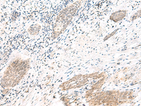 Immunohistochemistry of paraffin-embedded Human esophagus cancer tissue using ARL2BP Polyclonal Antibody at dilution of 1:50 (×200)