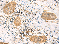 Immunohistochemistry of paraffin-embedded Human esophagus cancer tissue using UBD Polyclonal Antibody at dilution of 1:50 (×200)