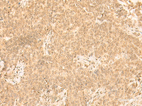 Immunohistochemistry of paraffin-embedded Human ovarian cancer tissue using ST8SIA4 Polyclonal Antibody at dilution of 1:50 (×200)