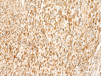 Immunohistochemistry of paraffin-embedded Human gastric cancer tissue using SMUG1 Polyclonal Antibody at dilution of 1:50 (×200)