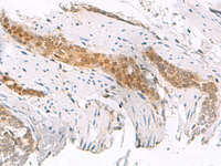 Immunohistochemistry of paraffin-embedded Human esophagus cancer tissue using SCAND1 Polyclonal Antibody at dilution of 1:50 (×200)