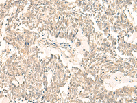 Immunohistochemistry of paraffin-embedded Human lung cancer tissue using GINS2 Polyclonal Antibody at dilution of 1:50 (×200)