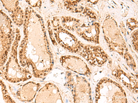 Immunohistochemistry of paraffin-embedded Human thyroid cancer tissue using FUNDC2 Polyclonal Antibody at dilution of 1:60 (×200)