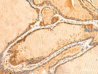 Immunohistochemistry of paraffin-embedded Human thyroid cancer tissue using PPM1B Polyclonal Antibody at dilution of 1:50 (×200)