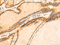 Immunohistochemistry of paraffin-embedded Human thyroid cancer tissue using LYZL1 Polyclonal Antibody at dilution of 1:50 (×200)