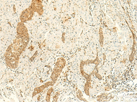 Immunohistochemistry of paraffin-embedded Human esophagus cancer tissue using ARL4D Polyclonal Antibody at dilution of 1:50 (×200)