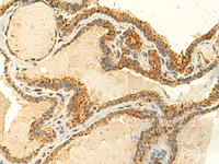 Immunohistochemistry of paraffin-embedded Human thyroid cancer tissue using MTHFS Polyclonal Antibody at dilution of 1:50 (×200)