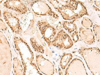 Immunohistochemistry of paraffin-embedded Human thyroid cancer tissue using RPL13A Polyclonal Antibody at dilution of 1:60 (×200)