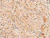 Immunohistochemistry of paraffin-embedded Human liver cancer tissue using HEBP2 Polyclonal Antibody at dilution of 1:60 (×200)