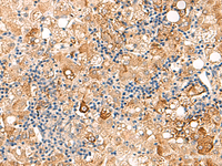 Immunohistochemistry of paraffin-embedded Human liver cancer tissue using SEC22B Polyclonal Antibody at dilution of 1:70 (×200)