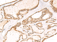 Immunohistochemistry of paraffin-embedded Human thyroid cancer tissue using DCAF10 Polyclonal Antibody at dilution of 1:55 (×200)