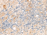 Immunohistochemistry of paraffin-embedded Human liver cancer tissue using THNSL1 Polyclonal Antibody at dilution of 1:70 (×200)