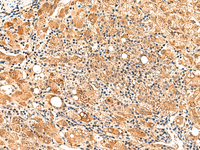 Immunohistochemistry of paraffin-embedded Human liver cancer tissue using PAFAH1B2 Polyclonal Antibody at dilution of 1:50 (×200)