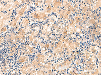 Immunohistochemistry of paraffin-embedded Human liver cancer tissue using MRPL16 Polyclonal Antibody at dilution of 1:60 (×200)