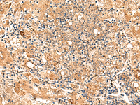 Immunohistochemistry of paraffin-embedded Human liver cancer tissue using GALNT12 Polyclonal Antibody at dilution of 1:70 (×200)