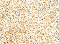 Immunohistochemistry of paraffin-embedded Human gastric cancer tissue using HMBOX1 Polyclonal Antibody at dilution of 1:50 (×200)