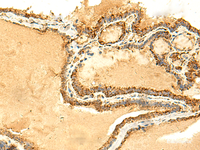 Immunohistochemistry of paraffin-embedded Human thyroid cancer tissue using ATP5PD Polyclonal Antibody at dilution of 1:50 (×200)