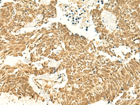 Immunohistochemistry of paraffin-embedded Human lung cancer tissue using POLR3F Polyclonal Antibody at dilution of 1:50 (×200)