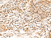 Immunohistochemistry of paraffin-embedded Human esophagus cancer tissue using RETREG1 Polyclonal Antibody at dilution of 1:50 (×200)