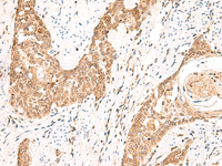 Immunohistochemistry of paraffin-embedded Human esophagus cancer tissue using PPP1R3C Polyclonal Antibody at dilution of 1:50 (×200)