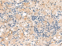 Immunohistochemistry of paraffin-embedded Human liver cancer tissue using DUSP7 Polyclonal Antibody at dilution of 1:50 (×200)