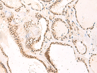 Immunohistochemistry of paraffin-embedded Human thyroid cancer tissue using TEAD3 Polyclonal Antibody at dilution of 1:50 (×200)
