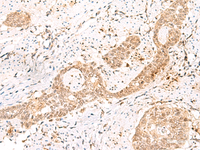 Immunohistochemistry of paraffin-embedded Human esophagus cancer tissue using PRKAG2 Polyclonal Antibody at dilution of 1:55 (×200)