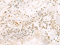 Immunohistochemistry of paraffin-embedded Human lung cancer tissue using PDS5A Polyclonal Antibody at dilution of 1:90 (×200)