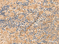 Immunohistochemistry of paraffin-embedded Human liver cancer tissue using PTH1R Polyclonal Antibody at dilution of 1:55 (×200)